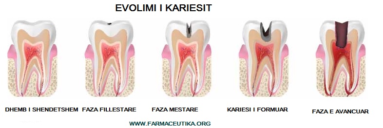 kavitet dhembi kariesi dentisti stomatolog