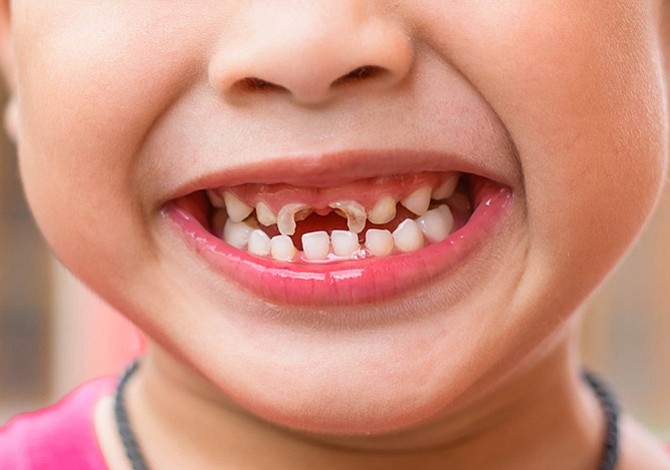 kavitet dhembi kariesi dentisti stomatolog