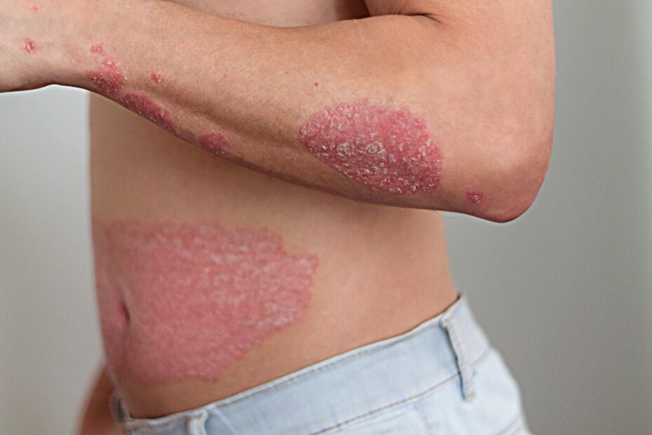 Trajtimi Psoriazes